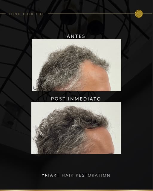 ✨Un trabajo milimétrico que marca la diferencia✨

El tratamiento a tu medida existe y puede empezar,