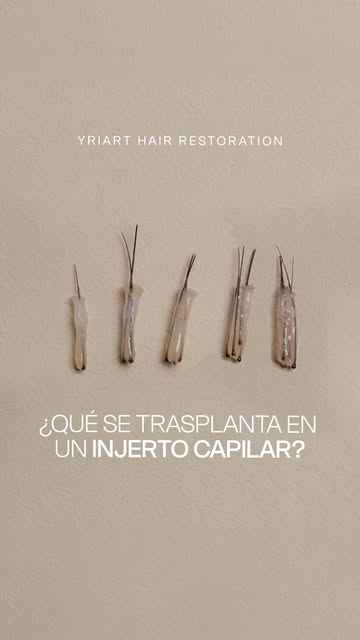 ¿Qué es lo que verdaderamente se trasplanta en un injerto capilar? 🔬

Hoy les respondemos esas duda