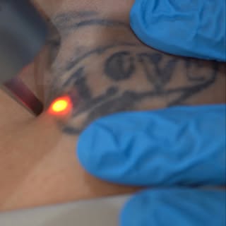 Do you hear that satisfying sound? This is the Picosure Pro laser, which helps clear pigment and tat