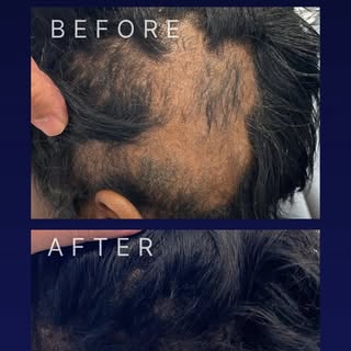 Alopecia areata hair loss can be very difficult to treat. This patient had multiple cortisone inject