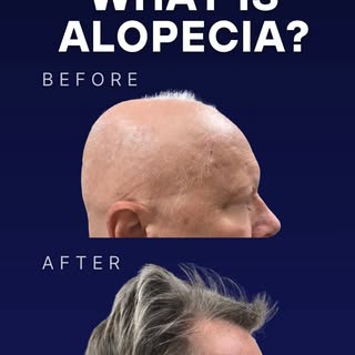 The word "alopecia" is a general term that means hair loss. There are many types of alopecia, such a