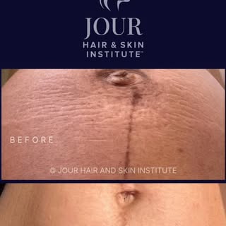 These beautiful results are 2 months after 2 sessions of our Jour laser protocol for tightening and 