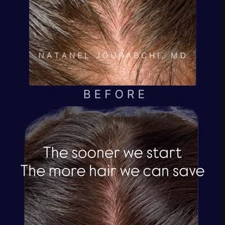 Hair loss in both women and men can have different causes. This is why it's important to see an expe
