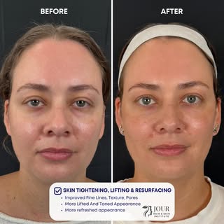 No fillers. No filters. No needles. 

Our Jour Protocol for tightening and resurfacing uses advanced