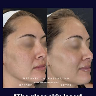 No makeup. No filter. No editing.

Just glass skin.

After a series of 2 PicoSure Pro treatments, he