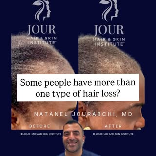 She had already tried treatments elsewhere and was still losing hair.

The reason?

She didn’t have 