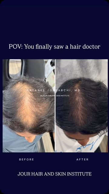 Six months. No oral medications. 
A remarkable transformation 🙌🏽

This patient came to us looking 