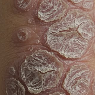 Psoriasis isn’t just dry skin. It can appear as red, raised patches with silvery scales and may affe