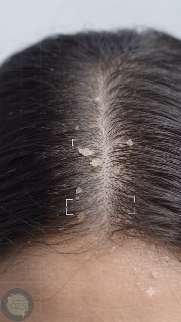 Not every flaky scalp is just dandruff 👀
Persistent flakes? Don’t ignore them—find the cause. 🩺✨

