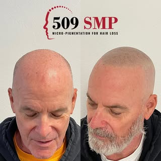🚨 Failed Hair Transplant 🚨 
When I say failed I mean it did not meet the expectations of the clien