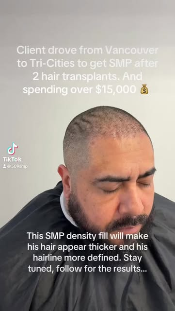 This client drove from over 3 hours away to get his his SMP done after getting 2 hair transplants an