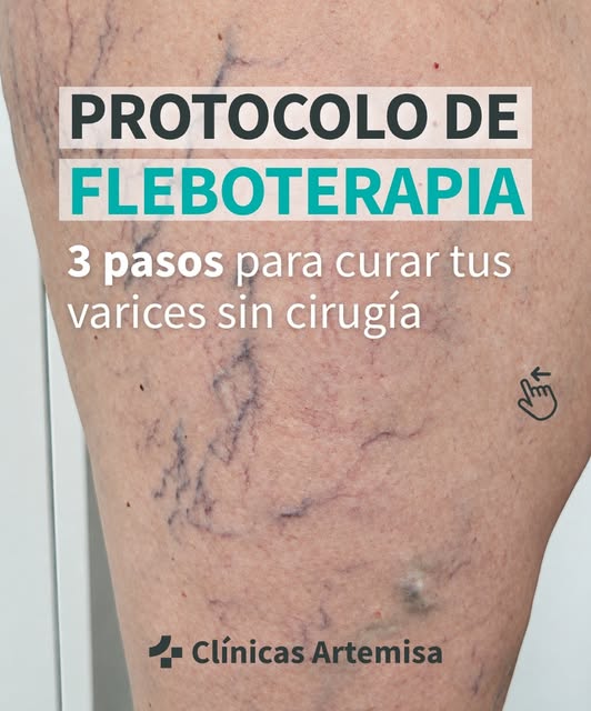 ¡Dile adiós a las varices sin cirugía con nuestro tratamiento de Fleboterapia Regenerativa! ✨ Desliz