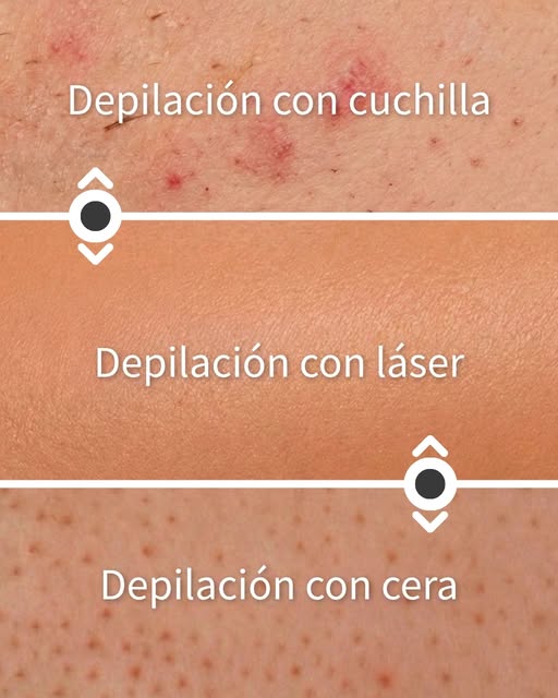 ¿Sabías que el método con el que te depilas cambia por completo la salud y el aspecto de tu piel? 🔍