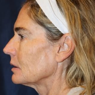 Our beautiful patient underwent a #DiamondFacialRejuvenation with a Facelift & Necklift, Browlift, U