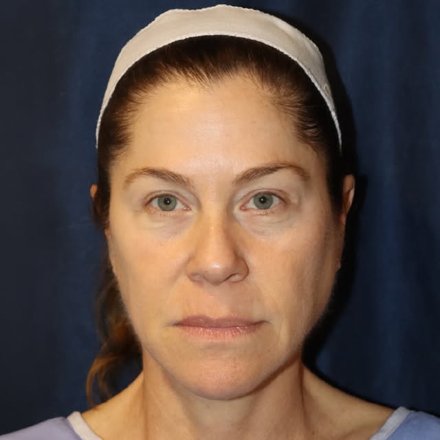 #DiamondFacialRejuvenation - take the years back. You deserve them.

Here, we did a Facelift, Neckli