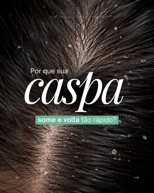 Se você tá cansada de conviver com caspa que some e volta, agende uma avaliação no link da bio para 