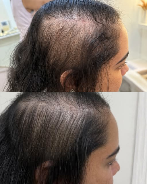 Alopecia é como um quebra-cabeça: cada pessoa tem SUAS peças. 🧩

Tentar encaixar uma solução pronta