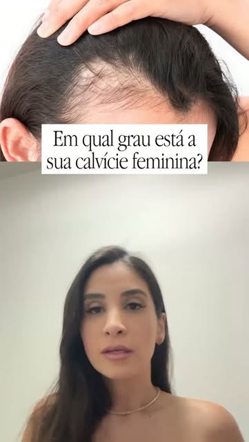 Seu cabelo está caindo em níveis normais? Ou já está entrando nos estágios de calvície?

Veja o víde