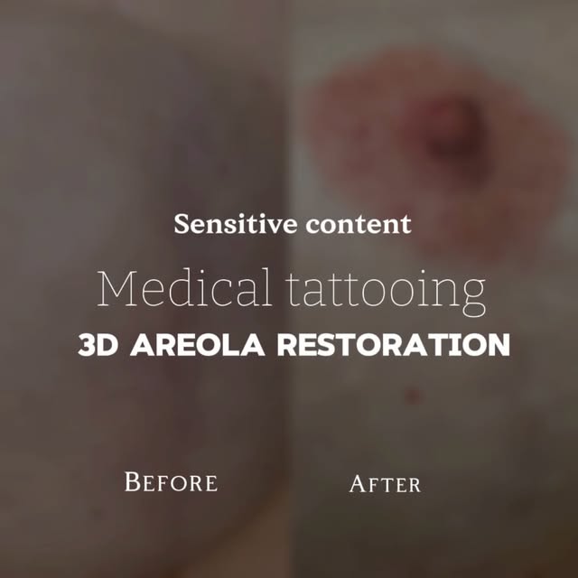 3D Areola Restoration | Medical Tattooing

More than a tattoo — this is about restoring what was los