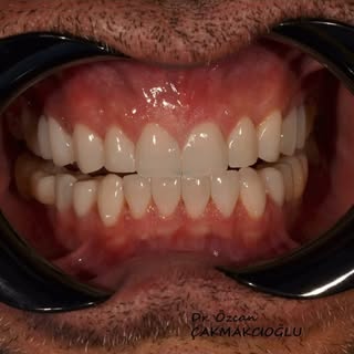 Posterior overlays and anterior veneers  to bring our patients 30 years ago smile line back 🙂

🦷 D