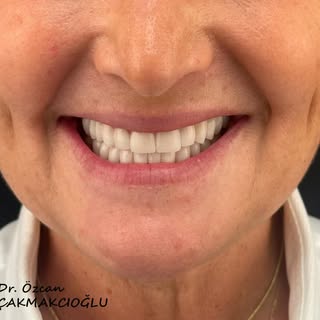 Rehabilitation of both arches for better proportion and smile line 🙂

🦷 Dr. Özcan Çakmakcıoğlu
📞 