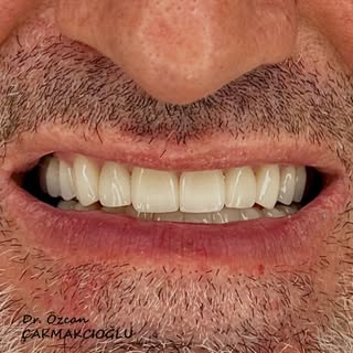 Rehabilitation of both arches for better proportion and smile line 🙂

🦷 Dr. Özcan Çakmakcıoğlu
📞 