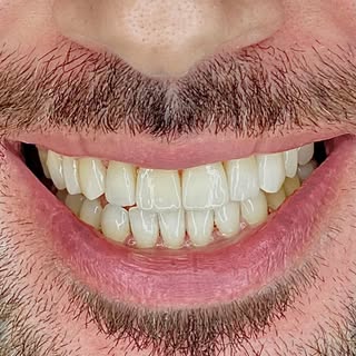 Prepless veneers on top for better proportion and smile line 🙂

🦷 Dr. Özcan Çakmakcıoğlu
📞 0545 2