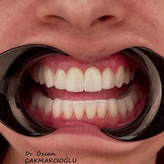 Multidisciplinary treatments  performed  for better proportion and smile line 🙂

🦷 Dr. Özcan Çakma