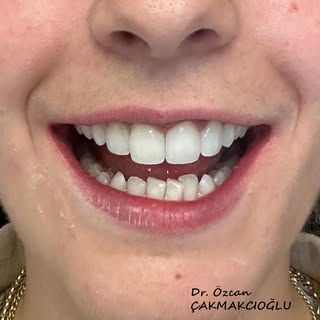 Just 4 unit Prepless veneers on top for better proportion and smile line 🙂

🦷 Dr. Özcan Çakmakcıoğ