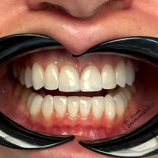 20 unit Prepless veneers for better proportion and smile line 🙂

🦷 Dr. Özcan Çakmakcıoğlu
📞 0545 