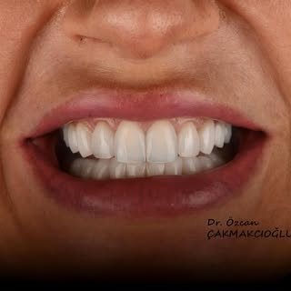 Prepless veneers  for better proportion and smile line 🙂

🦷 Dr. Özcan Çakmakcıoğlu
📞 0545 288 58 