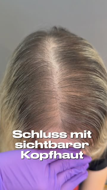 SCHLUSS MIT SICHTBARER KOPFHAUT 💜

Anfang 30 und trotzdem schon seit vielen Jahren mit lichtem Haar