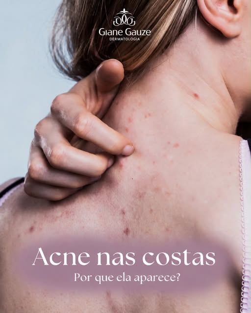 Acne nas costas: por que ela aparece?

A acne não se limita ao rosto. As costas também podem apresen