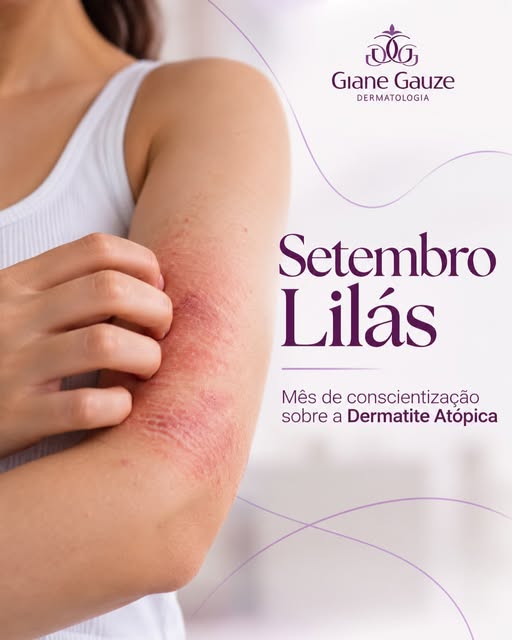 SETEMBRO LILÁS 💜
Mês de conscientização sobre a Dermatite Atópica

A dermatite atópica é uma doença