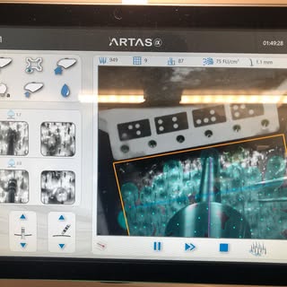 Another perfect ARTAS harvest leads to excellent results yet again.  The advanced tech used by the A