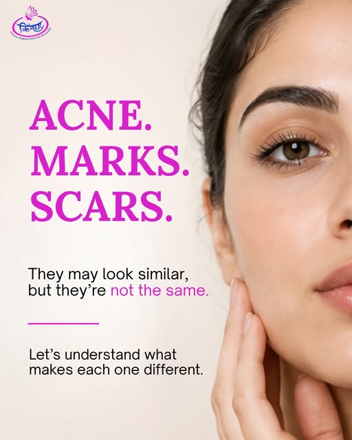 One breakout can leave behind more than you think. 👀✨

Active acne, marks and scars are not the sam