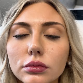 Lip filler correction is not a democracy. We don’t give both sides the exact same treatment just to 