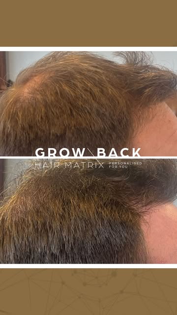 Hair loss doesn't look the same for everyone. So why would the same approach work for everyone?

Thi