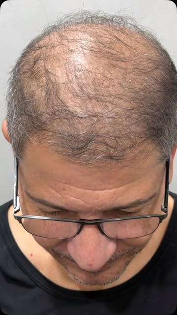 MEU PREÇO
NÃO É PELO QUE EU FAÇO, É PELO PROBLEMA QUE EU RESOLVO#calvicie #transplantecapilarfue #al