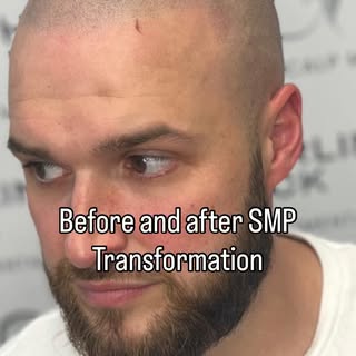 🔥Still undecided whether to take the plunge and get scalp micropigmentation? 

It is a big step but
