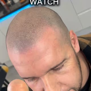 #hairloss #scalpmicropigmentation #barnsley #hairlinetattoo #malebaldnesstreatment