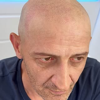New client today starting his hairloss transformation with me 😬. 
Watch me…
✅Design his brand new h