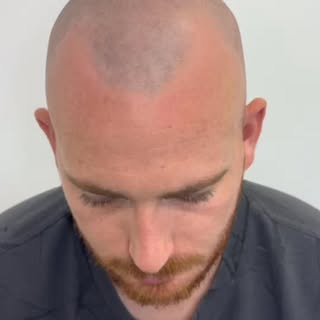Receded hairline correction work right here ⬇️.
If you’re starting to recede and want a lower hairli
