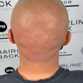 Third session today for my Alopecia Totalis client. He had unexpectedly lost all his hair due to Alo