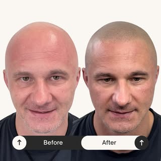 ⭐️Alopecia Totalis hairloss transformation⭐️. 
4 sessions. Covering the entire scalp. Amazing result