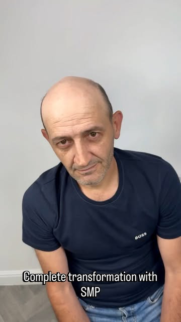 Complete hairloss transformation for my lovely client Luli. Hats no longer required 🕺

How did I do