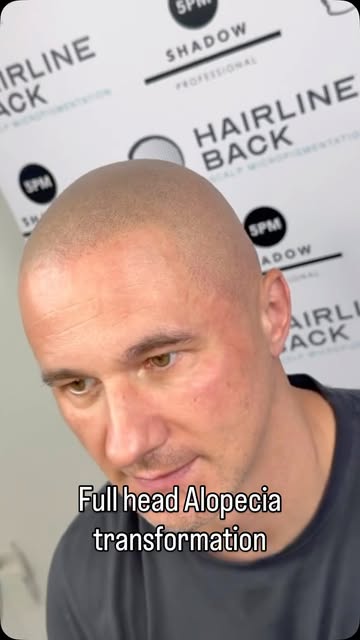 Full head Alopecia client. 
Complete hairloss transformation right here. 
How did I do this ? 
✅ 4 s