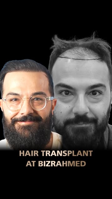 Impressive Hair Transplant Results | Before & After | Best hair transplant center in Dubai 
Why is B