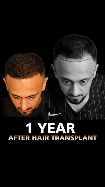 Listen to our happy patient share his inspiring journey with Hair Transplant - Bizrahmed Centre

Why