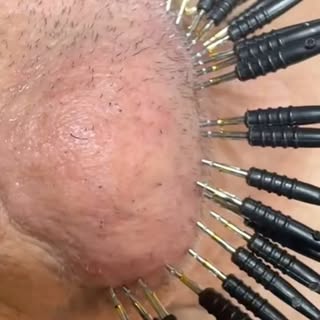 We specialize in all modalities and methods of electrolysis. 

Electrolysis is the only FDA and Amer
